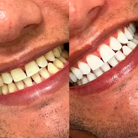 especialidade clareamento dental 2
