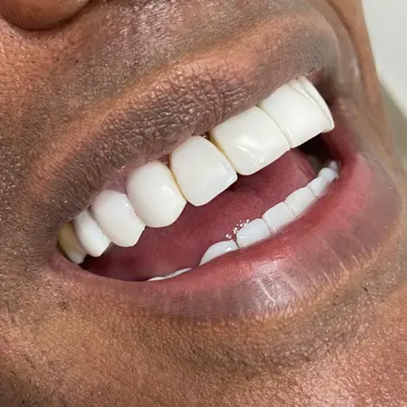 especialidade implantes